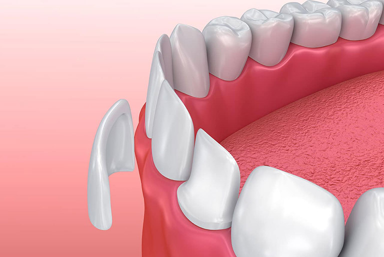 Dán răng sứ là phương pháp thẩm mỹ cho răng bằng cách dán trực tiếp miếng sứ lên bề mặt bên ngoài của răng