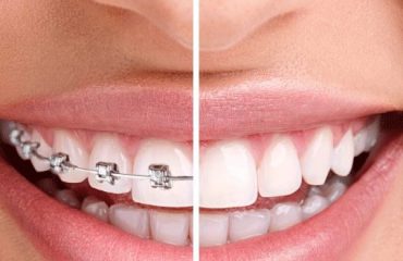 Khi nào bạn nên bọc răng sứ và khi nào nên niềng năng?