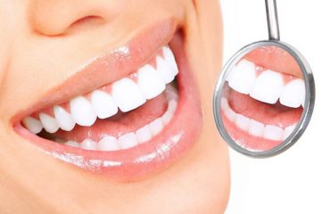 Tại sao lại thực hiện niềng răng sau khi đã bọc răng sứ?