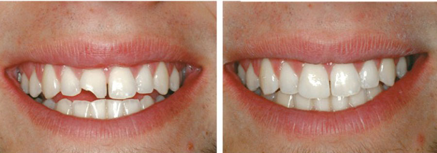 Cải thiện khả năng nhai và làm đẹp cho hàm răng bị vỡ bằng bọc sứ